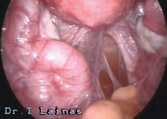 Adhesions (Laparoscopic image)